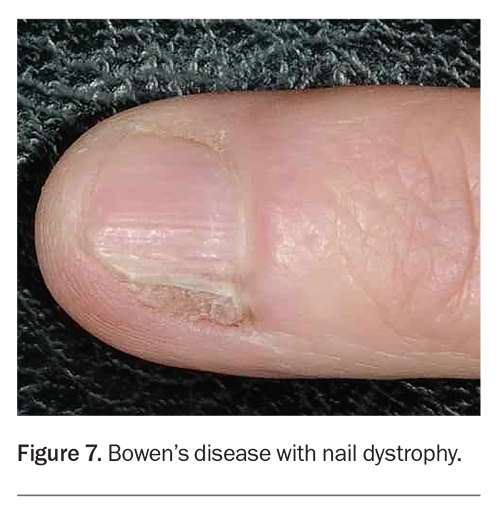 Evaluation and management of nail diseases Medicine Today